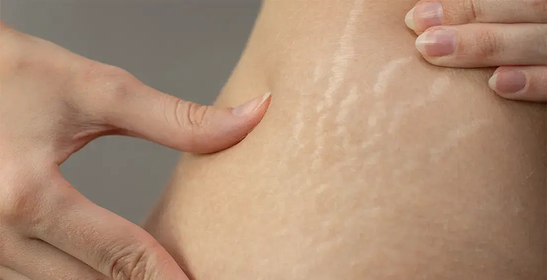 Can Collagen Help with Stretch Marks and Skin Healing?