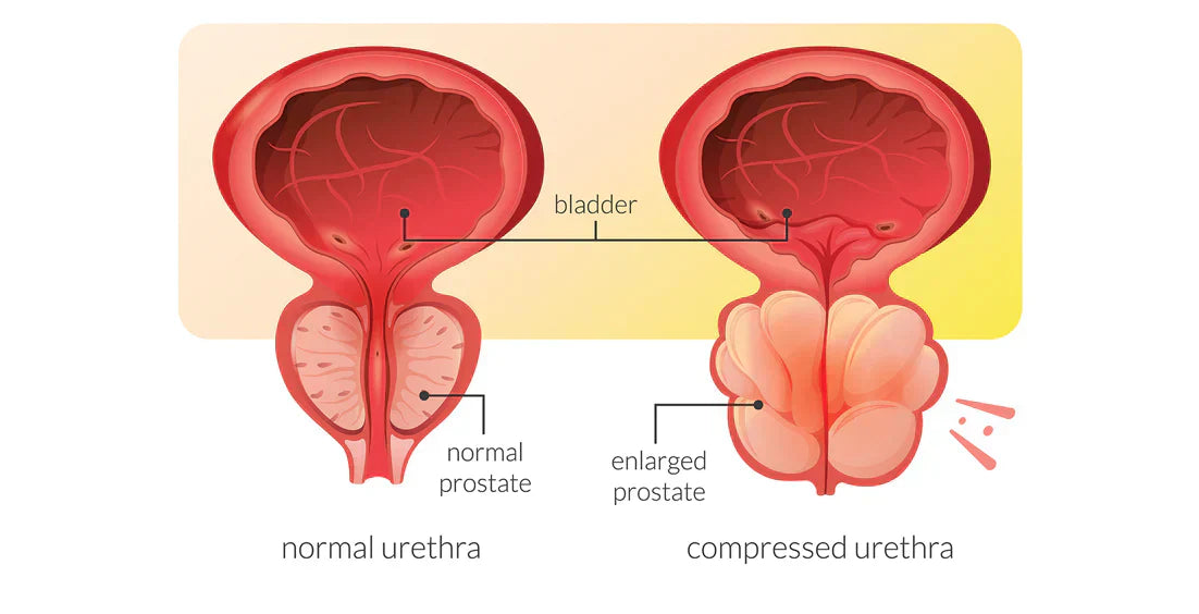Normal Prostate and Enlarged Prostate